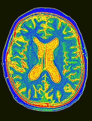 Resonancia magnética de un cerebro afectado por el Alzheimer (zonas azules y verdes) Resonancia magnética de un cerebro afectado por el Alzheimer (zonas azules y verdes)